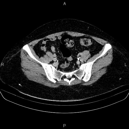 Adrenal cortical carcinoma (Radiopaedia 84882-100379 Axial C+ delayed 75).jpg