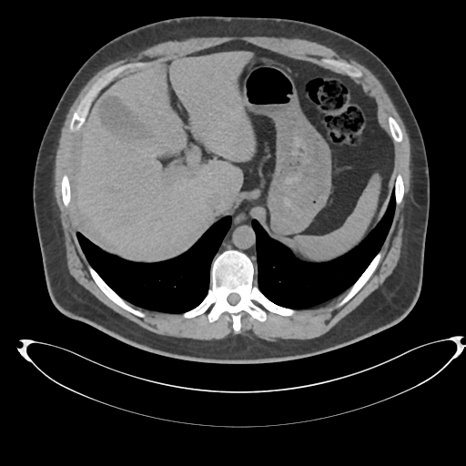 File:Adrenal cyst (Radiopaedia 45625-49778 Axial non-contrast 17).png