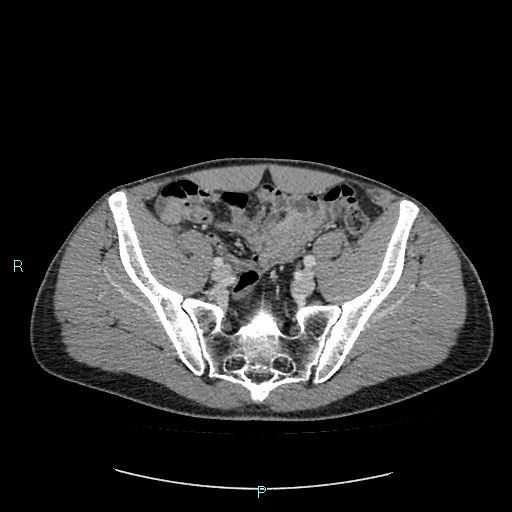 Adrenal cystic lymphangioma (Radiopaedia 83161-97534 Axial C+ portal venous phase 77).jpg