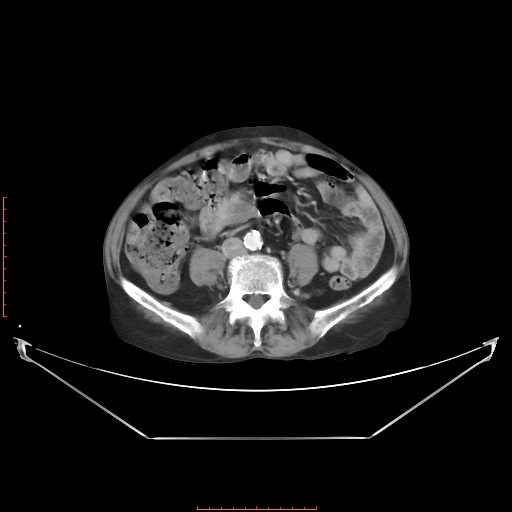 Adrenal hemangioma (Radiopaedia 68923-78668 Axial C+ portal venous phase 45).jpg