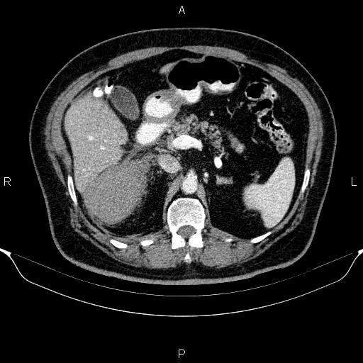 Adrenal hemorrhage (Radiopaedia 62622-70916 Axial C+ portal venous phase 63).jpg