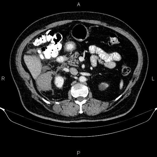 Adrenal hemorrhage (Radiopaedia 62622-70916 Axial C+ portal venous phase 72).jpg