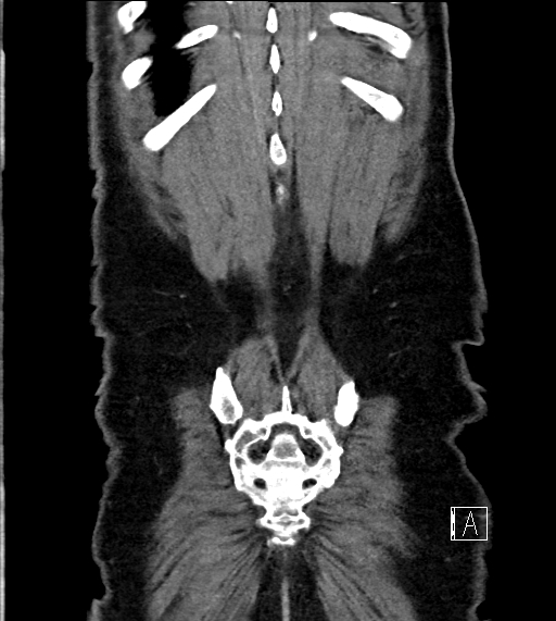 Adrenal lymphoma (Radiopaedia 73730-84529 Coronal C+ portal venous phase 75).jpg