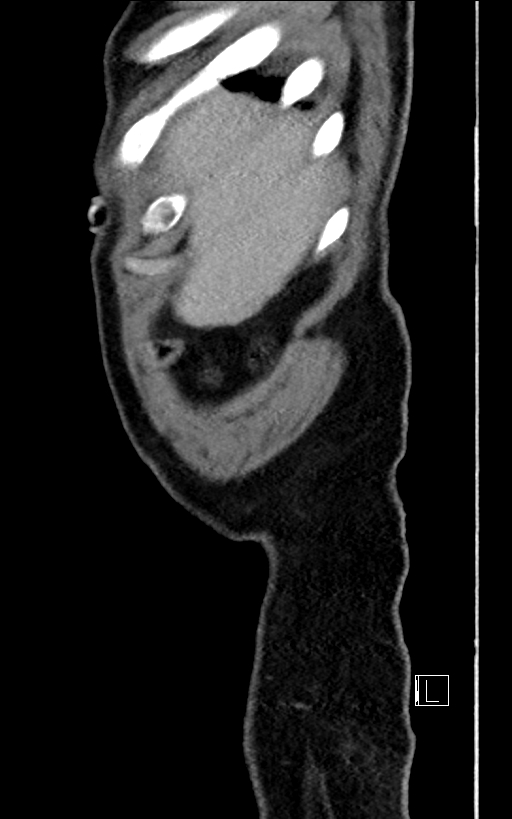 Adrenal lymphoma (Radiopaedia 73730-84529 Sagittal C+ portal venous phase 6).jpg