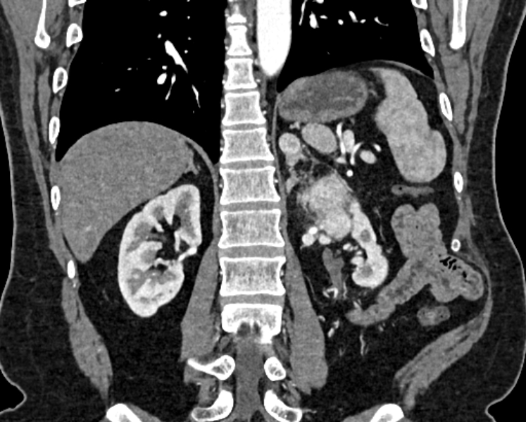 File:Adrenal metastases (Radiopaedia 73082-83791 Coronal C+ arterial phase 50).jpg