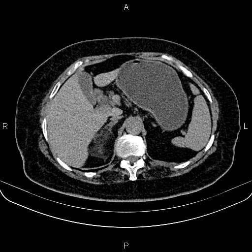Adrenal myelolipoma (Radiopaedia 82742-96986 Axial non-contrast 38).jpg