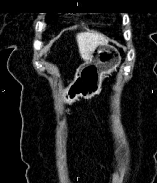 Adrenal myelolipoma (Radiopaedia 82742-96986 Coronal renal cortical phase 14).jpg