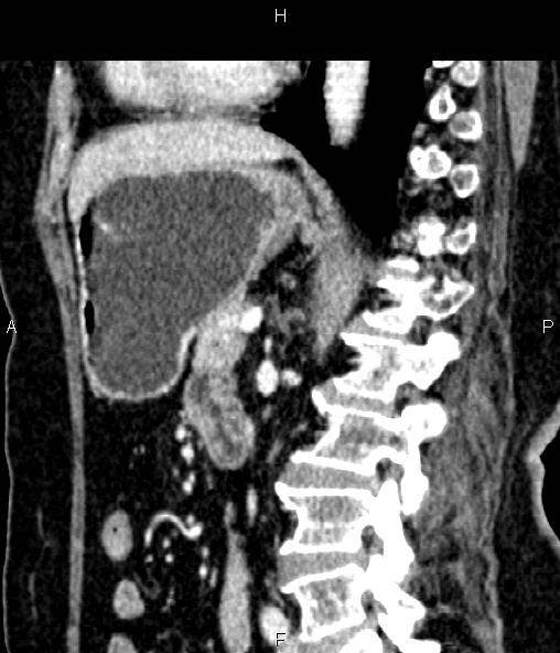 Adrenal myelolipoma (Radiopaedia 82742-96986 Sagittal renal cortical phase 64).jpg