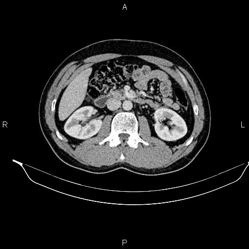 Adrenal myelolipoma (Radiopaedia 87794-104246 Axial renal cortical phase 46).jpg