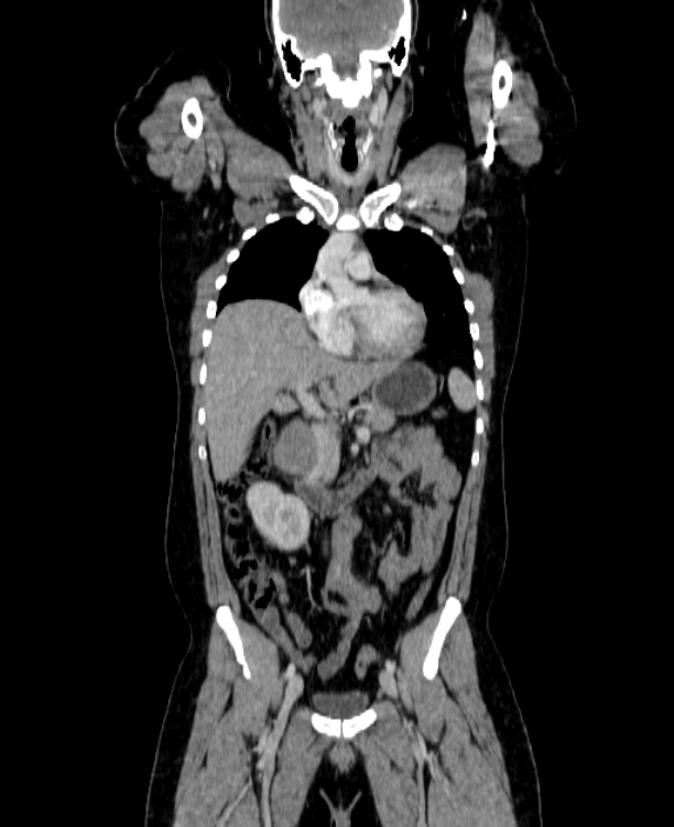 Adrenocortical carcinoma (Radiopaedia 80134-93438 Coronal C+ portal venous phase 70).jpg