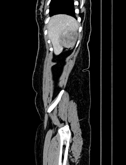 Adrenocortical carcinoma (Radiopaedia 87281-103569 Sagittal C+ portal venous phase 17).jpg