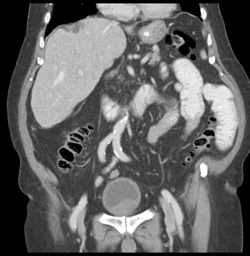 Adult ileal intussusception with secondary obstruction (Radiopaedia 30395-31051 Coronal C+ portal venous phase 29).jpg