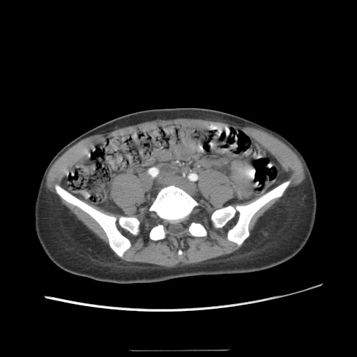 File:Adult polycystic kidney disease (Radiopaedia 48845-53876 Axial renal cortical phase 52).jpg