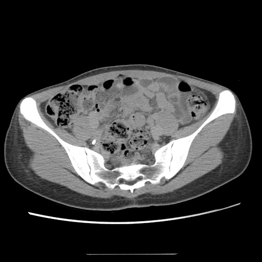 Adult polycystic kidney disease (Radiopaedia 48845-53876 Axial renal excretory phase 72).jpg