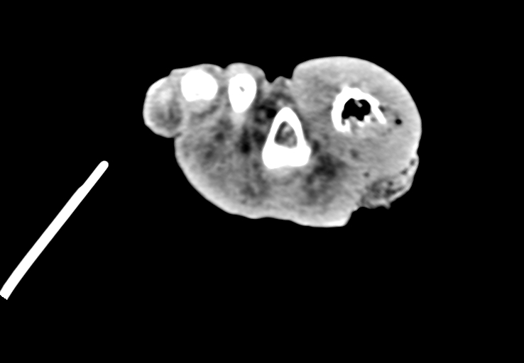 Advanced osteomyelitis due to open metatarsal fracture (Radiopaedia 83891-99095 Axial non-contrast 48).jpg
