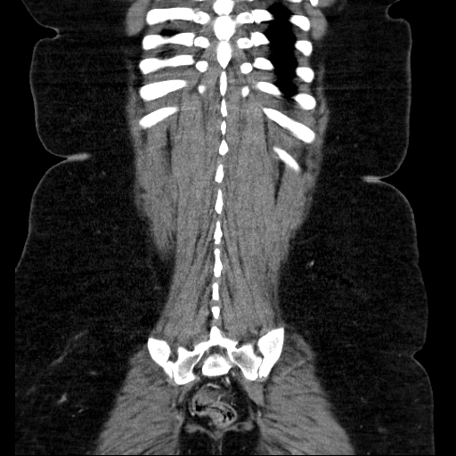 File:Afferent loop syndrome - secondary to incarcerated trocar site hernia (Radiopaedia 82959-97305 Coronal C+ portal venous phase 123).jpg