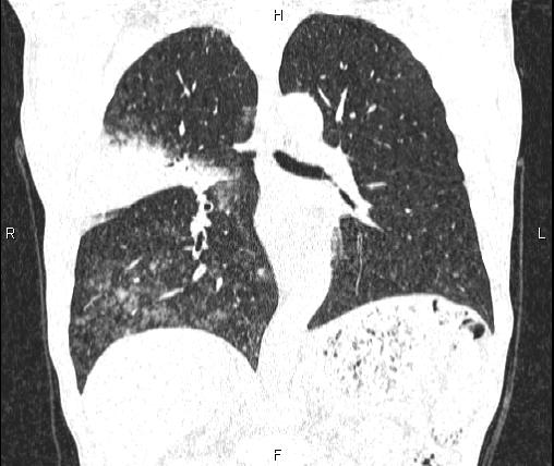 Air bronchogram in pneumonia (Radiopaedia 85719-101512 Coronal lung window 35).jpg
