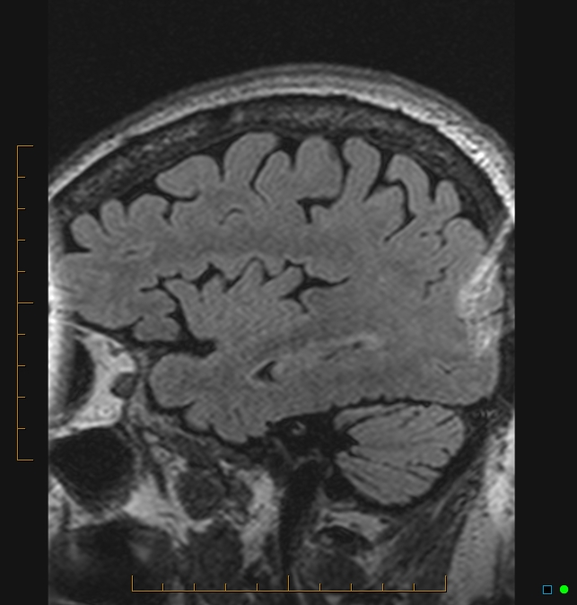 Aliasing artifact causing a spurious cerebellar lesion (Radiopaedia 48783-53810 Sagittal FLAIR 103).jpg