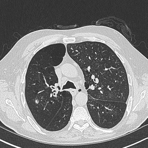 Allergic bronchopulmonary aspergillosis (Radiopaedia 44760-48571 Axial lung window 24).png