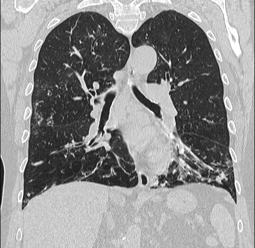 Alpha-1-antitrypsin deficiency (Radiopaedia 72058-82557 Coronal lung window 48).jpg