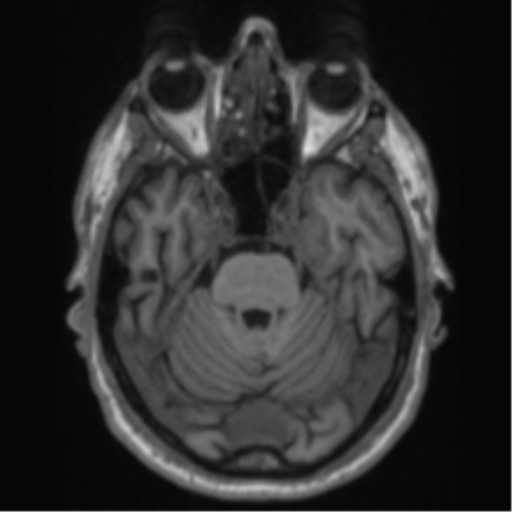 File:Alzheimer's disease- with Gerstmann syndrome and dressing apraxia (Radiopaedia 54882-61150 Axial T1 22).png