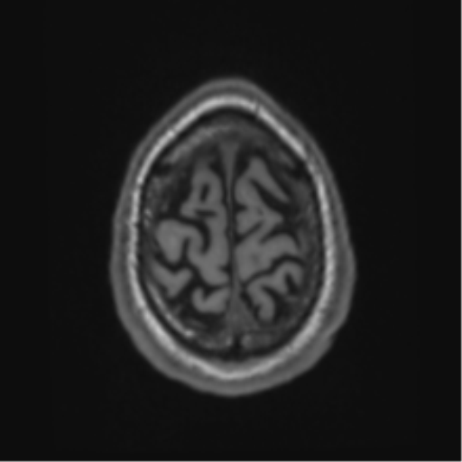 Alzheimer's disease- with Gerstmann syndrome and dressing apraxia (Radiopaedia 54882-61150 Axial T1 68).png