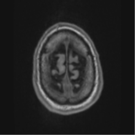 File:Alzheimer's disease- with apraxia (Radiopaedia 54763-61011 Axial T1 70).png