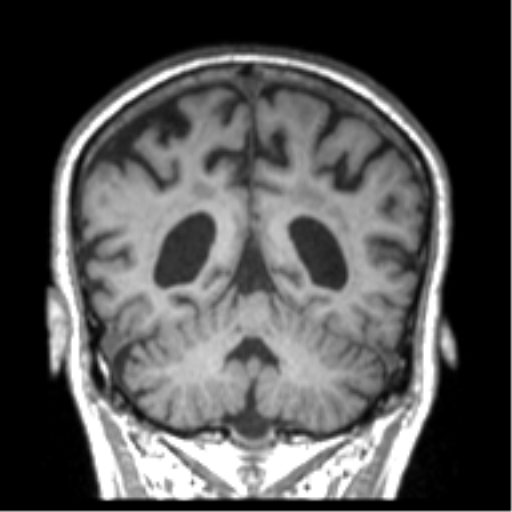 Alzheimer disease and cerebral amyloid angiopathy (Radiopaedia 64234-73011 Coronal T1 16).png