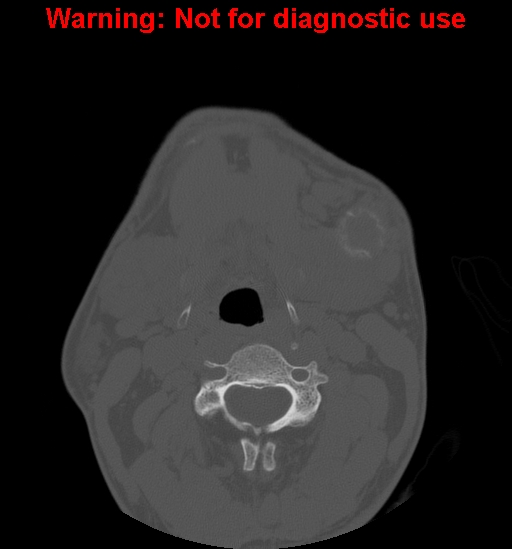 File:Ameloblastoma (Radiopaedia 13276-13280 Axial non-contrast 3).jpg