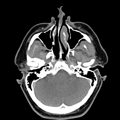 File:Ameloblastoma (Radiopaedia 38520-40623 Axial non-contrast 14).png