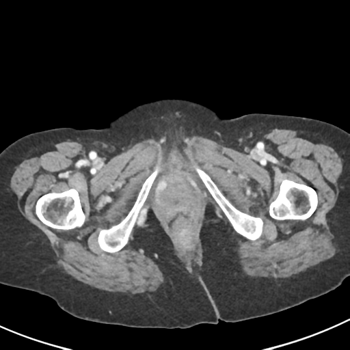 Ampullary adenocarcinoma (Radiopaedia 34013-35237 C 62).png