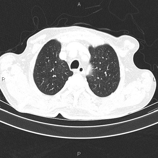 Ampullary adenocarcinoma (Radiopaedia 86093-102033 Axial lung window 20).jpg