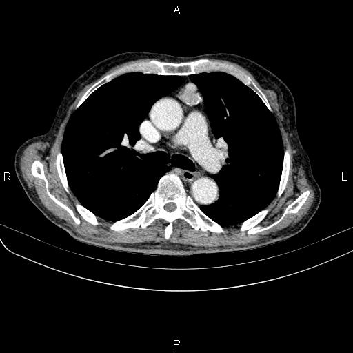 Ampullary adenocarcinoma (Radiopaedia 86093-102033 B 29).jpg