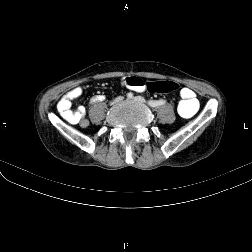 Ampullary adenocarcinoma (Radiopaedia 86093-102033 B 85).jpg