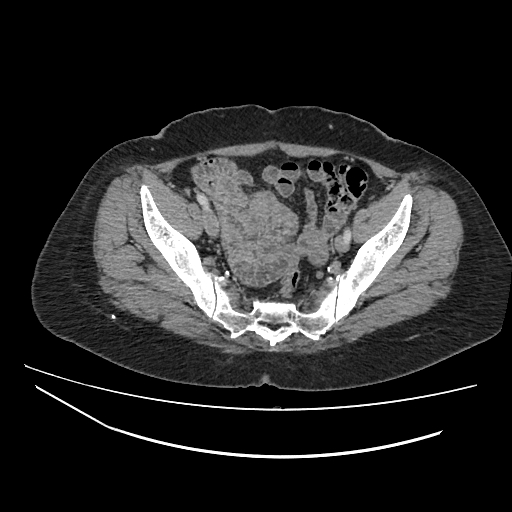 File:Ampullary tumor (Radiopaedia 60333-67998 A 75).jpg