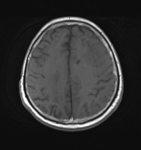 File:Amyloid angiopathy with inflammation (Radiopaedia 30360-31002 Axial T1 24).jpg