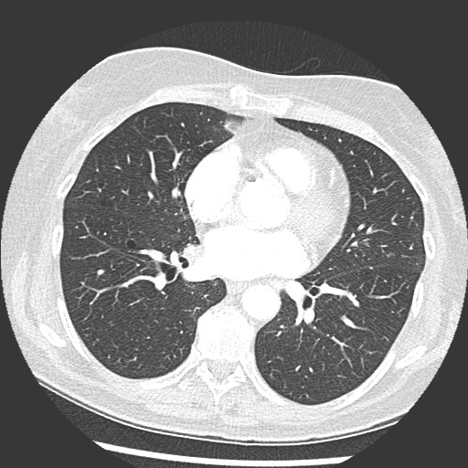 File:Amyloidosis - bronchial and diffuse nodular pulmonary involvement (Radiopaedia 60156-67745 Axial lung window 48).jpg