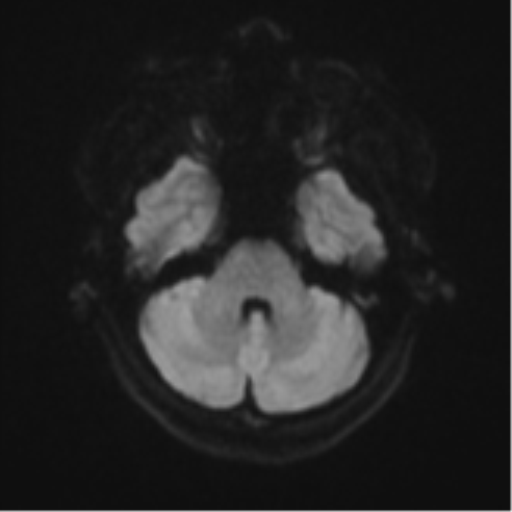 Anaplastic astroblastoma (Radiopaedia 55666-62194 Axial DWI 36).png