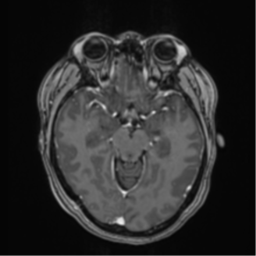 Anaplastic astroblastoma (Radiopaedia 55666-62194 Axial T1 C+ 30).png