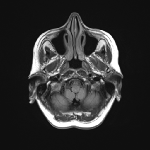 File:Anaplastic astrocytoma (Radiopaedia 86943-103160 Axial FLAIR 4).png