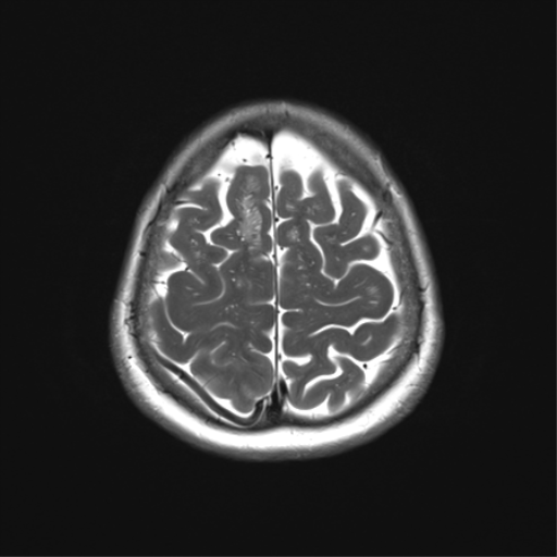 File:Anaplastic astrocytoma (Radiopaedia 86943-103160 Axial T2 32).png