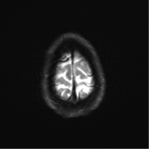 Anaplastic astrocytoma IDH mutant (Radiopaedia 50046-55341 Axial DWI 26).png
