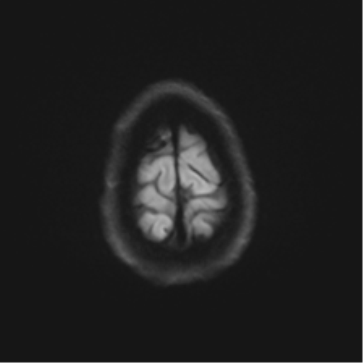 Anaplastic astrocytoma IDH mutant (Radiopaedia 50046-55341 Axial DWI 53).png