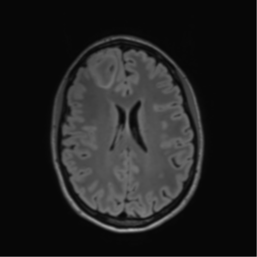 File:Anaplastic astrocytoma IDH mutant (Radiopaedia 50046-55341 Axial FLAIR 31).png