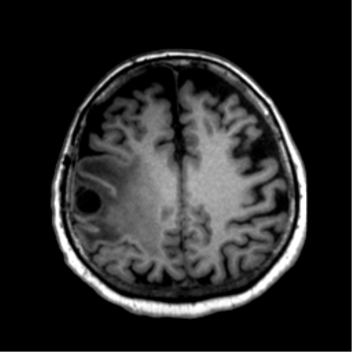 Anaplastic astrocytoma IDH wild-type (pseudoprogression) (Radiopaedia 42209-45277 Axial T1 94).png