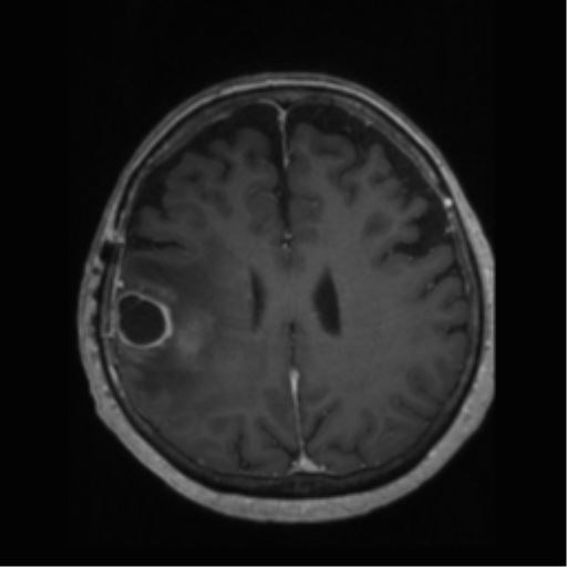 File:Anaplastic astrocytoma IDH wild-type (pseudoprogression) (Radiopaedia 42209-45277 Axial T1 C+ 83).png