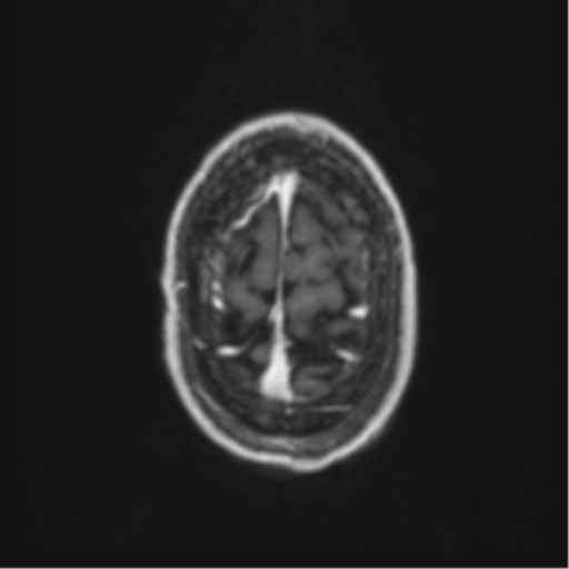 Anaplastic oligodendroglioma with skull fracture (Radiopaedia 74831-85845 Axial T1 C+ fat sat 61).png