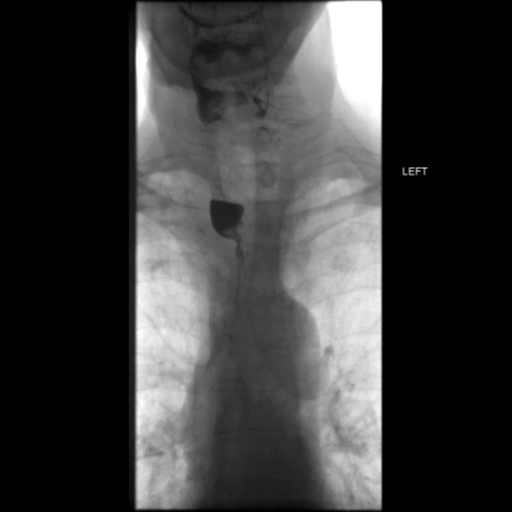 File:Anastomotic stricture post Ivor Lewis esophagectomy (Radiopaedia 47937-52715 Frontal 6).png