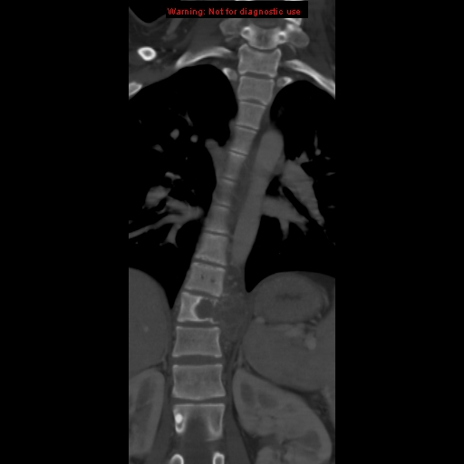 File:Aneurysmal bone cyst (Radiopaedia 9419-10102 Coronal bone window 6).jpg