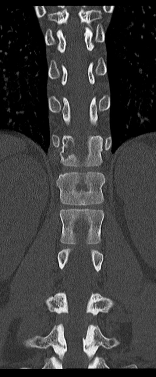 Aneurysmal bone cyst T11 (Radiopaedia 29294-29721 Coronal bone window 37).jpg